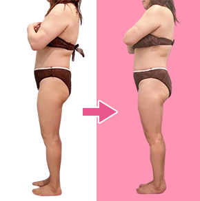 痩身ダイエットba02